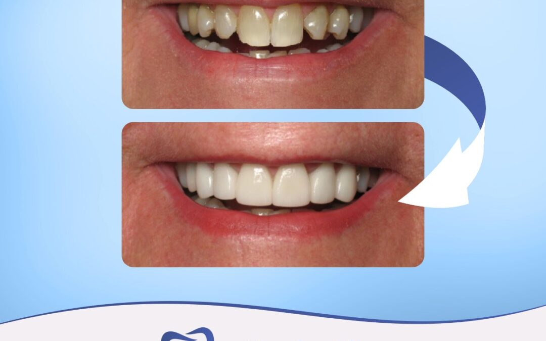 Porcelain veneers are one of the most popular cosmetic dental procedures available today