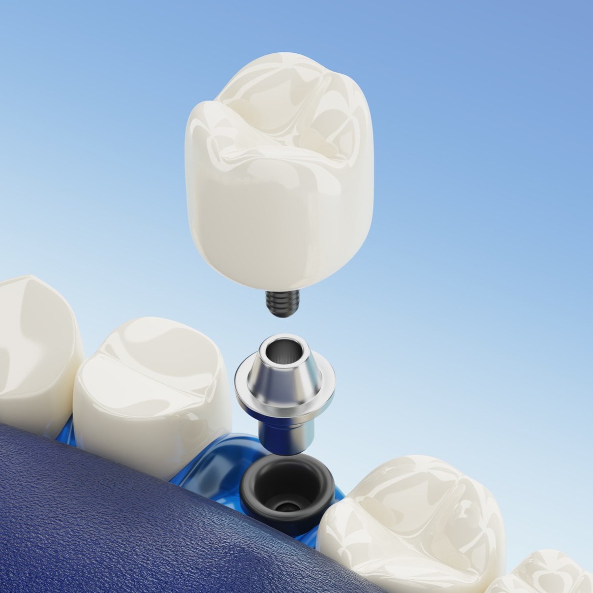 Advanced Restorative Dentistry and Implants
