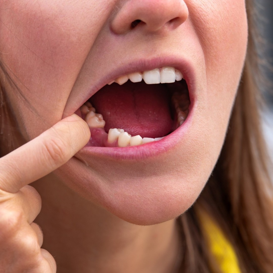 Dental Extraction Procedure Hackettstown NJ