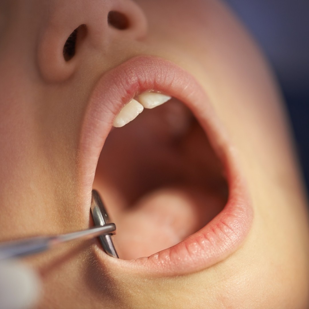 Dental Implants, Hackettstown, NJ