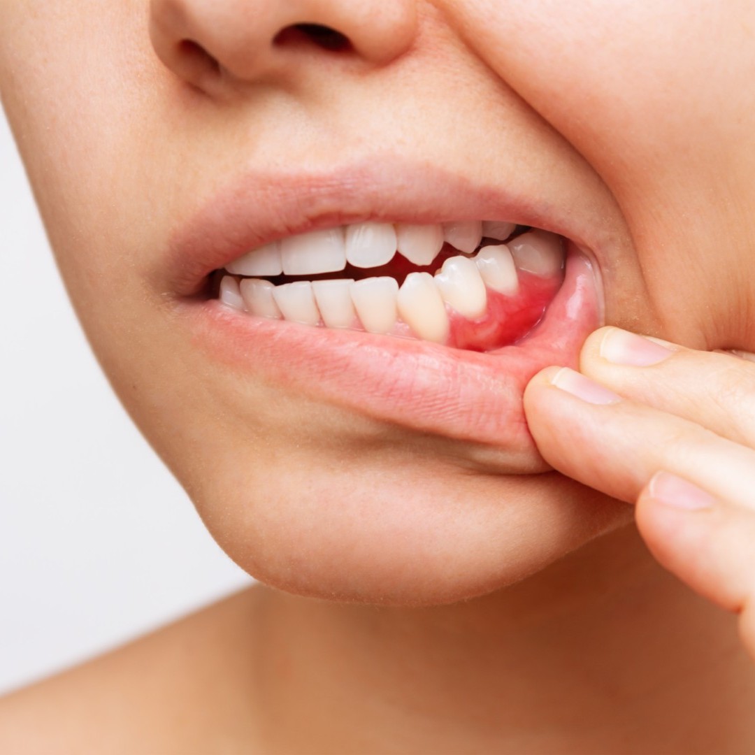 Oral Cancer Risk Factors Hackettstown NJ