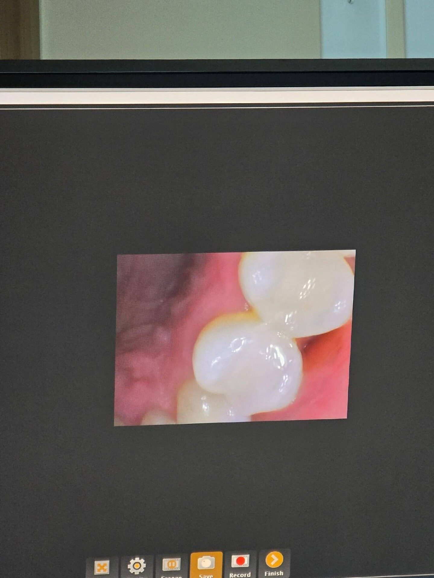 Intraoral Camera View